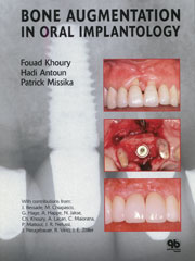 BONE AUGMENTATION IN ORAL IMPLANTOLOGY