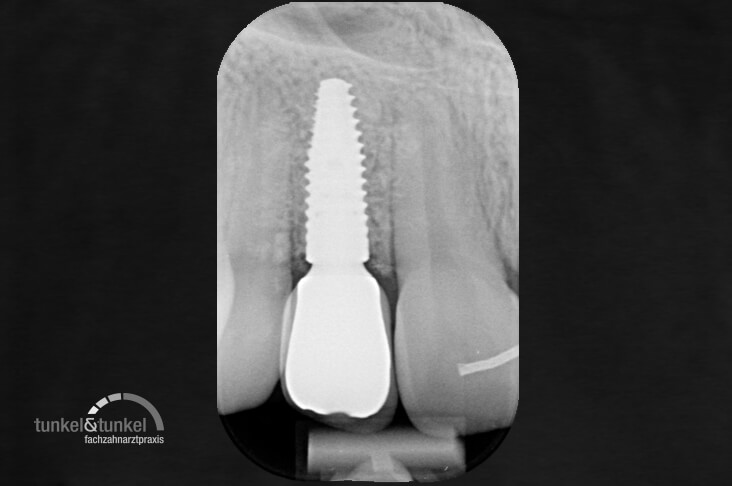 implantat_roentgenaufnahme implantat_roentgenaufnahme